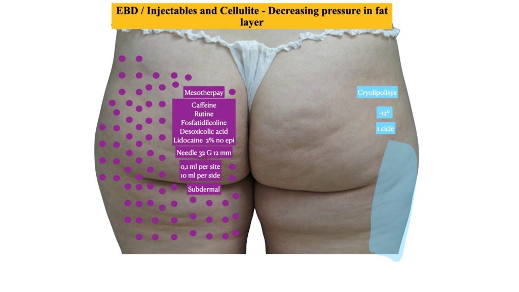 Figure 8 Decreasing fat pressures and projection with Cryolipolisis and mesotherapy