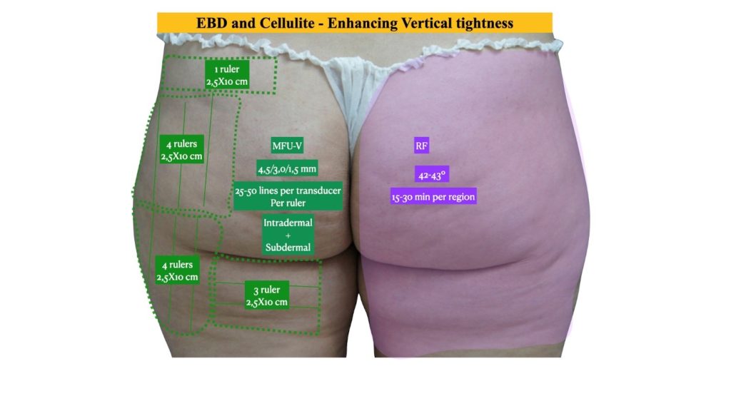 Figure 5 Enhancing Vertical vectors with EBD