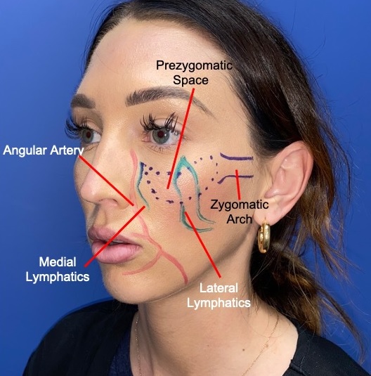 Orbital retaining ligament and zygomaticocutaneous ligaments forming the pre-zygomatic space (purple dots) superimposed on a youthful female face. The major arterial vasculature is also outlined in red as the angular artery, a continuation of the facial artery. Care should be taken in this region to avoid accidental intravascular injection. Emphasis should be placed on lateral volumization once the PZS has been entered with the blunt injection canula. The importance of the lymphatics in this area marked in green continue to be investigated and may contribute to prolonged edema when disrupted either surgically or following injectables.